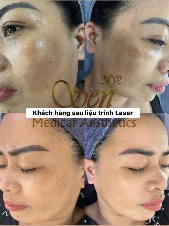 Khách hàng sau liệu trình Laser điều trị nám tại Thẩm Mỹ Sen