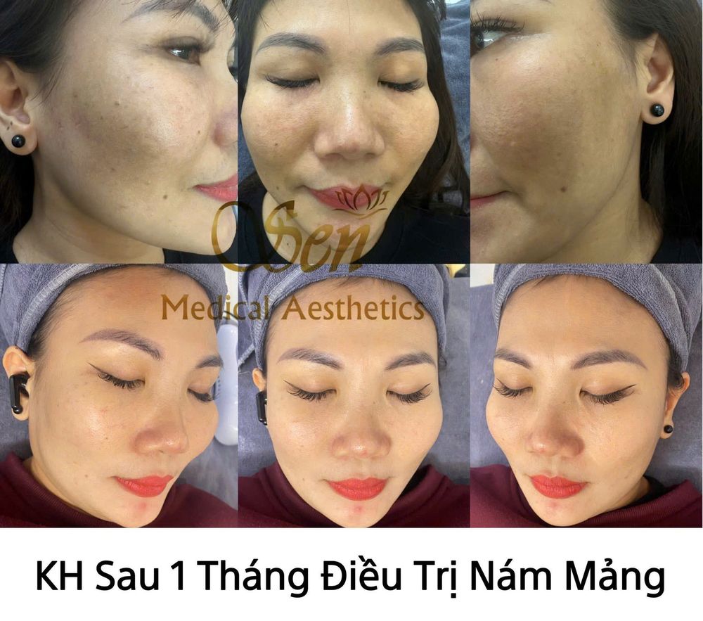 Khách hàng sau 1 tháng điều trị nám mảng
