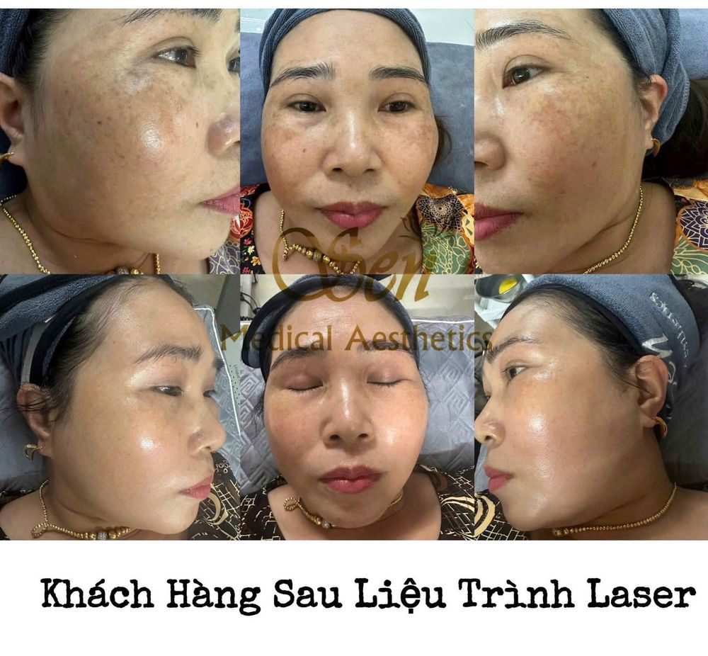 Khách hàng sau liệu trình Laser điều trị nám