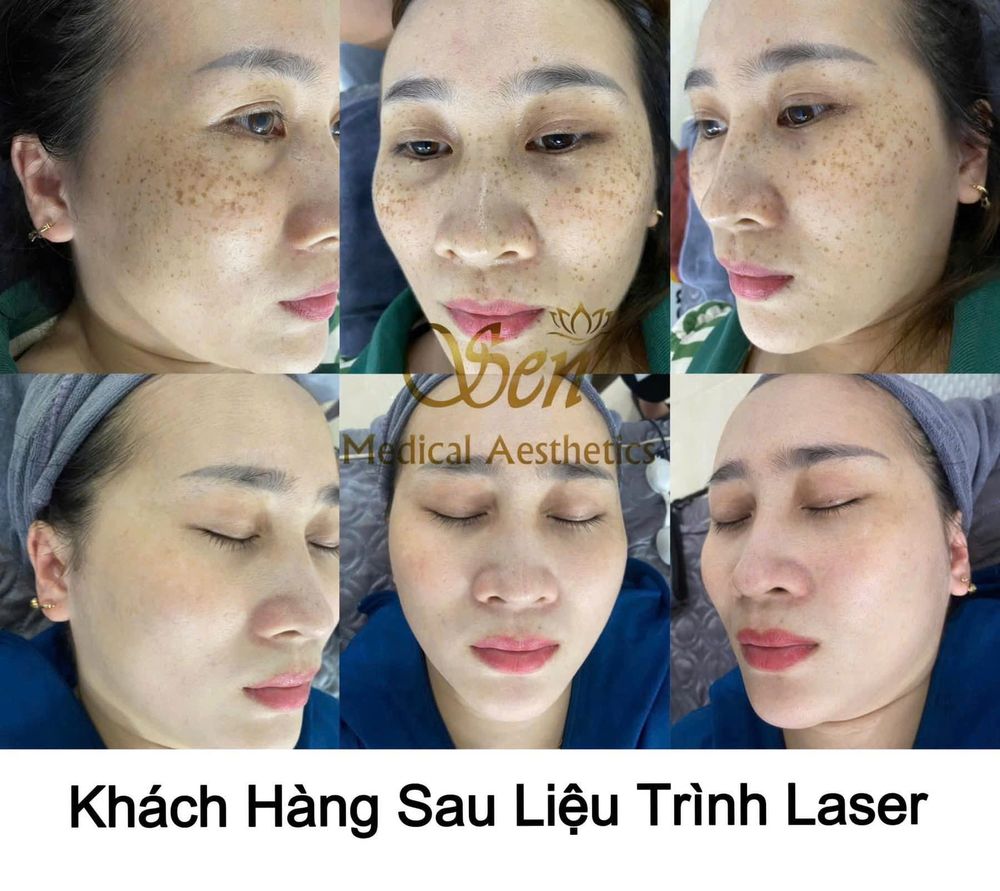 Khách hàng điều trị tàn nhang sau liệu trình Laser
