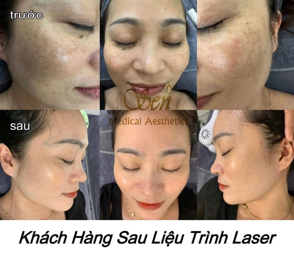 Khách hàng trước và sau điều trị nám